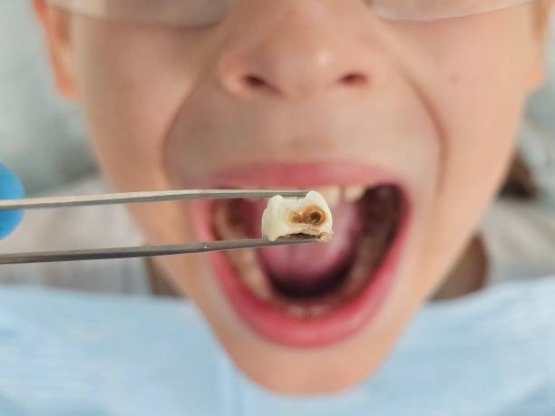 Best Emergency Tooth Extraction in Graysville, TN
